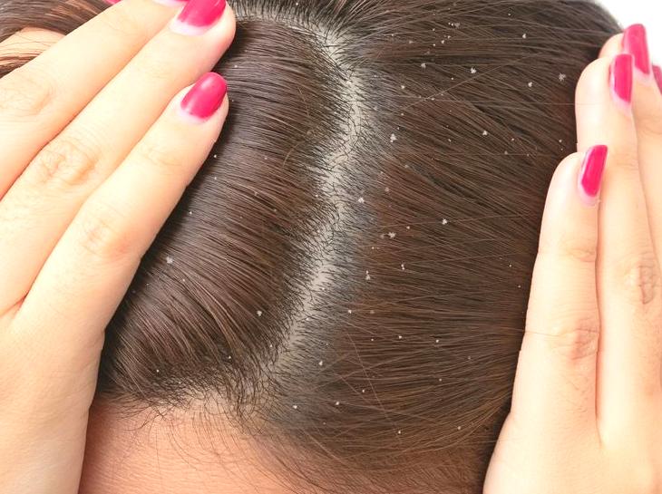 Tips for Preventing and Treating Dandruff