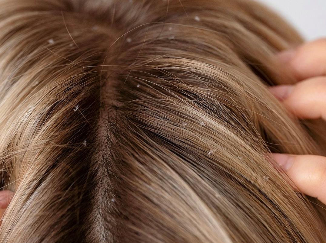 Guidelines for Combating Dandruff Issues