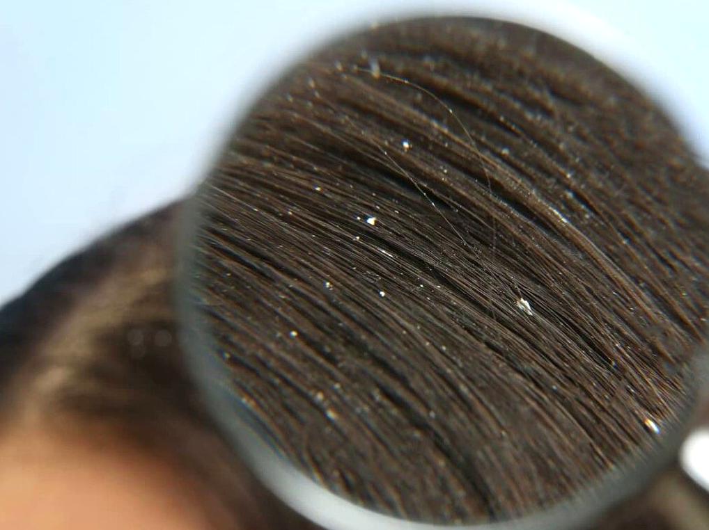 Methods for Preventing and Addressing Dandruff