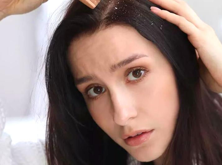 Tips for Dandruff Prevention and Treatment