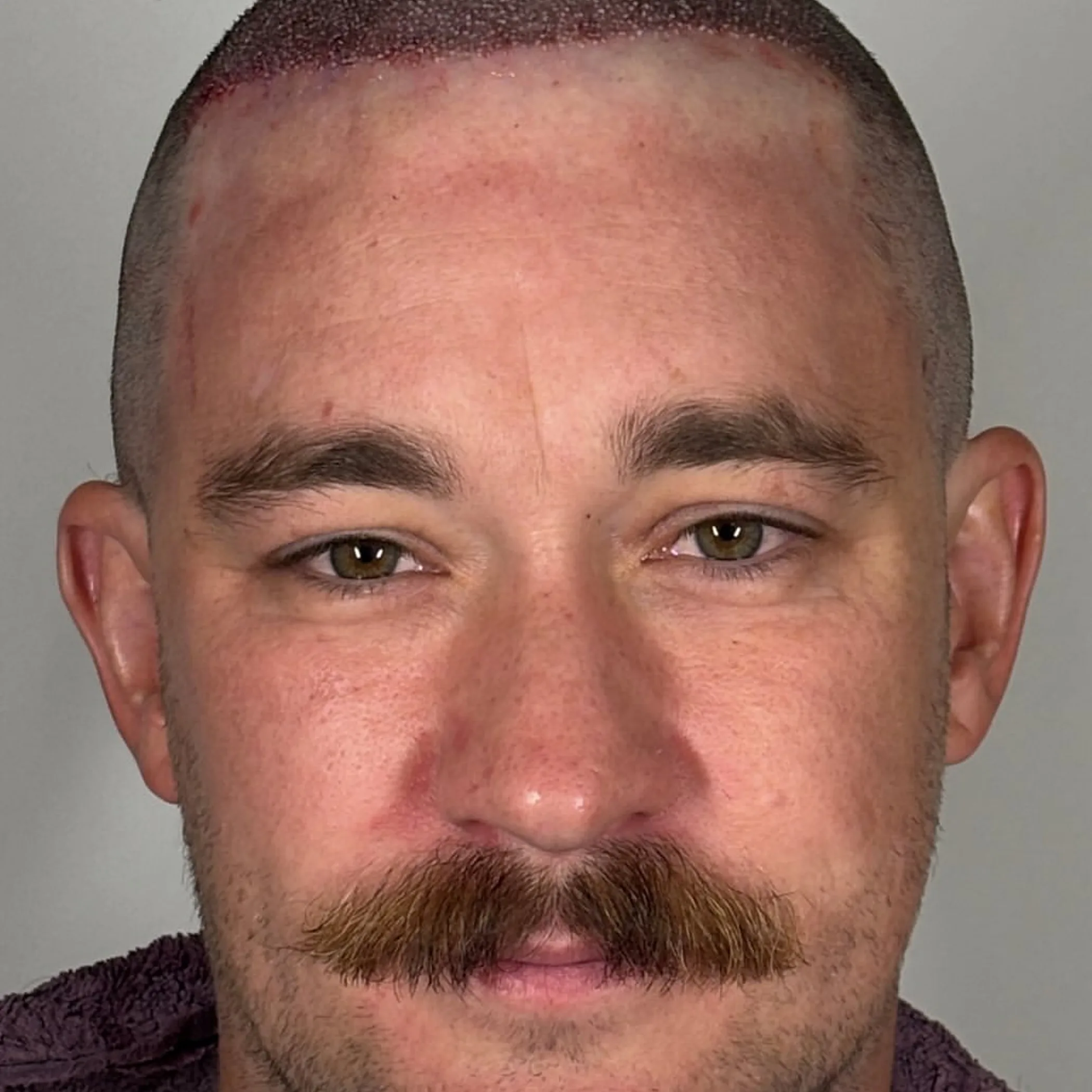 hair transplant recovery